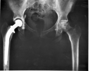 Hip_replacement_Image_3684-PH